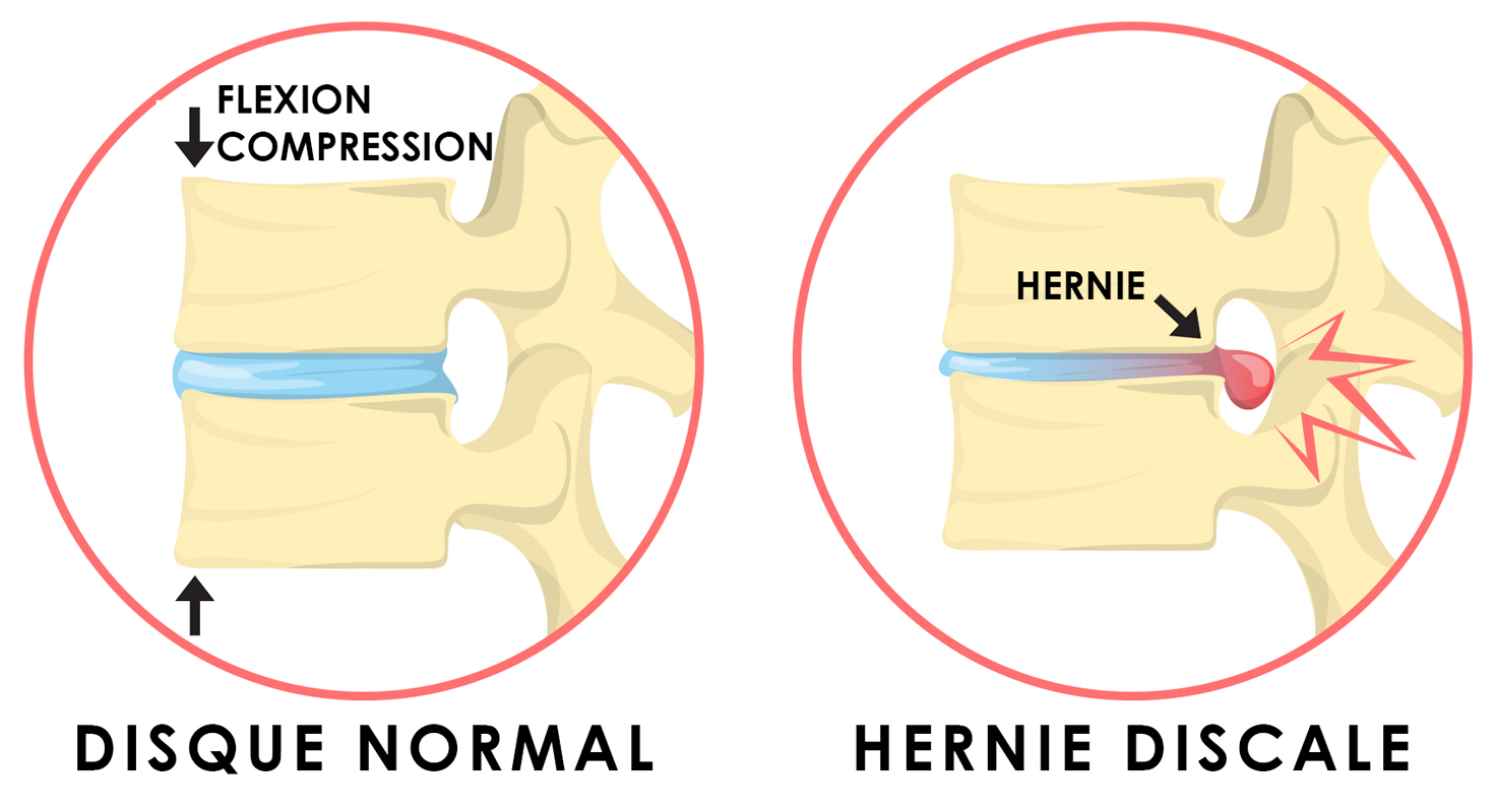 Pourquoi une hernie discale ?
